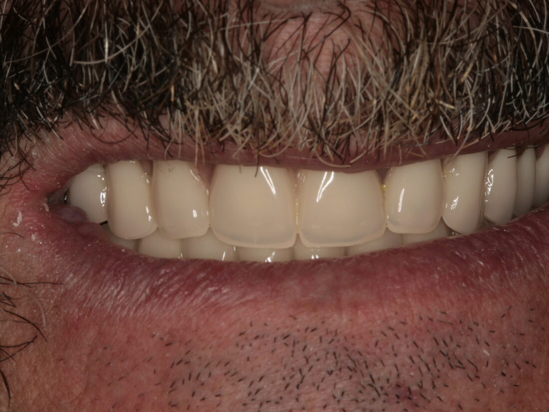 The same patient after treatment, smiling with a complete fixed upper arch of implant-supported teeth.