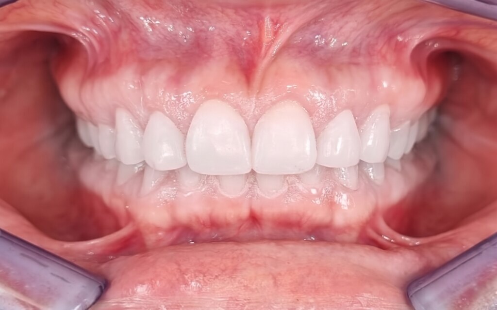 After treatment: the same patient with full-length, evenly shaped white restorations across both arches and the bite reopened
