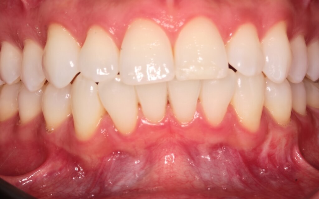 After treatment: the same patient with an even, aligned and naturally white front-tooth arrangement