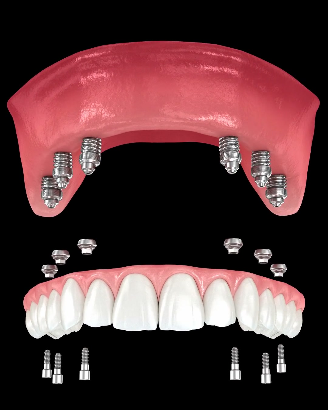 3D animation still: a full upper arch of teeth positioned above six implant posts set into the jaw.